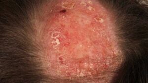 Manners Samlet Geografi Scabs and Sores on Scalp: Pictures, Causes, Treatment