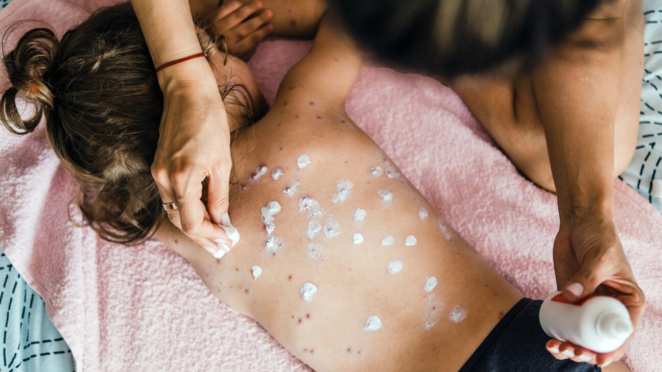 A child with measles is treated. 