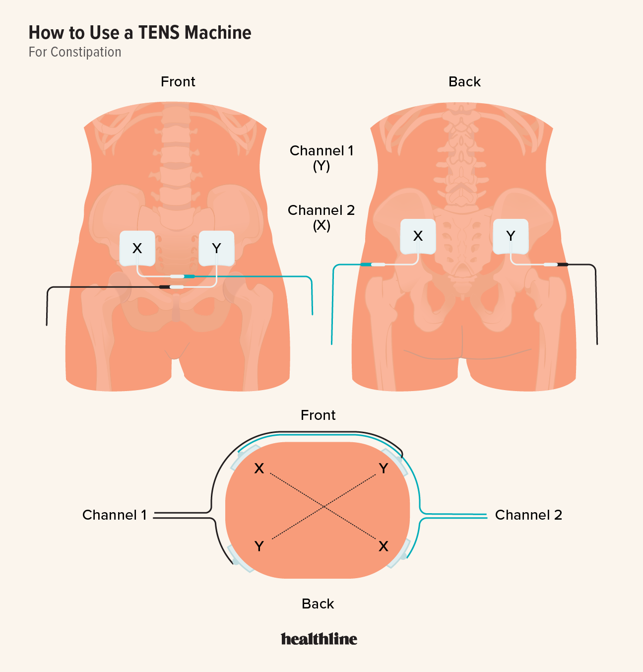 TENS Placement For Constipation Instructions And FAQs TENS Placement For Constipation Instructions And FAQs