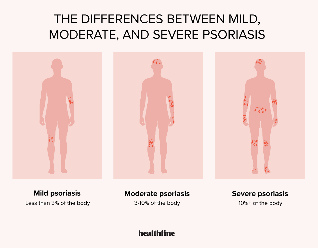 mild psoriasis