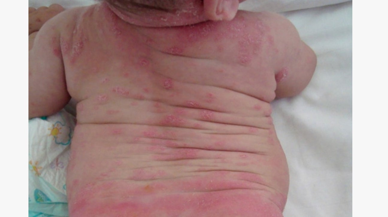 Baby Psoriasis Appearance, Diagnosis, and Management