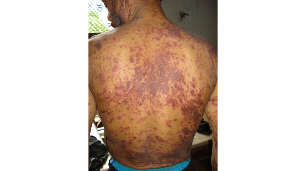 Dermatitis rash viral disease with immunodeficiency on body of