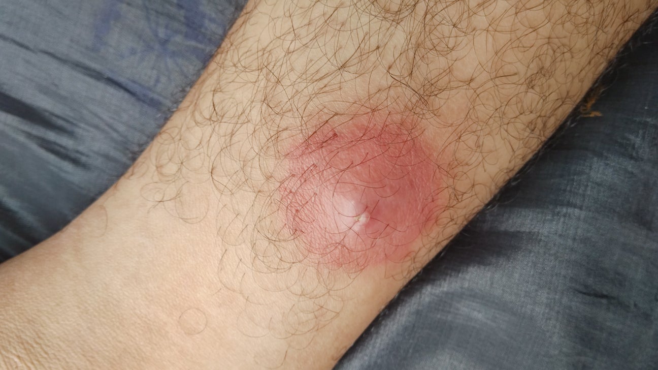 red bumps on skin not itchy
