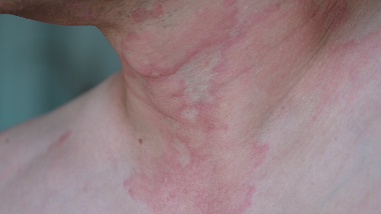 Hives Causes Risks Prevention And Pictures