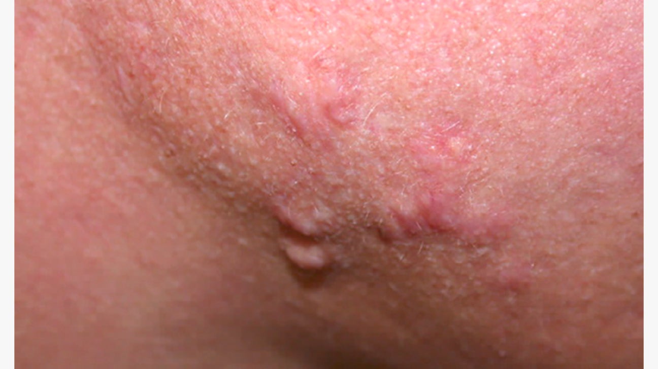 nodule skin