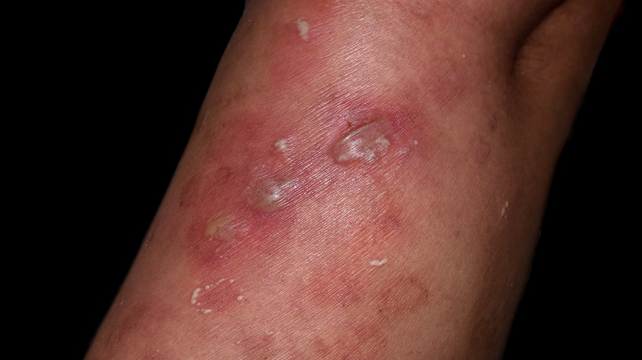 circular skin rashes on arms