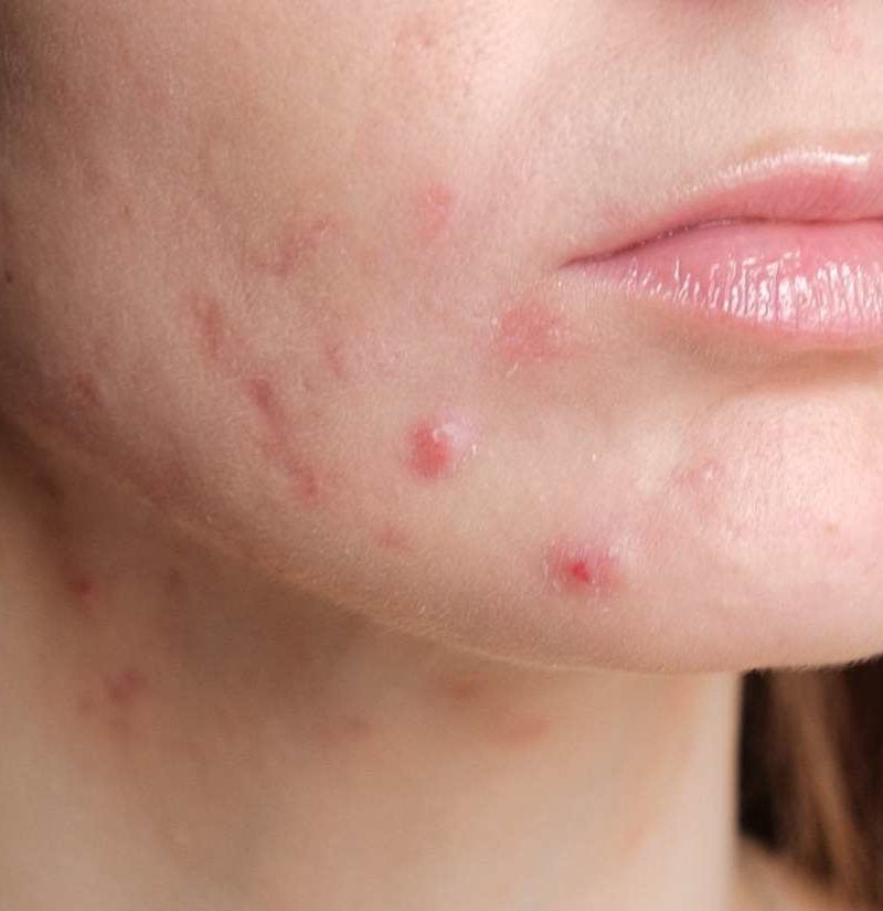 Is Acne Common During Pregnancy