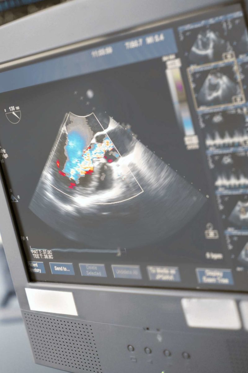 What is an echocardiogram? Uses, procedure, and results