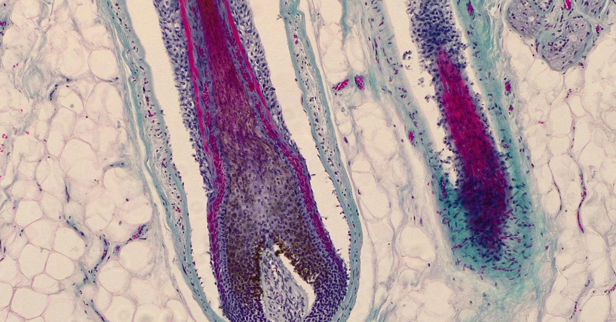 Hair follicles can be a site of origin for melanoma