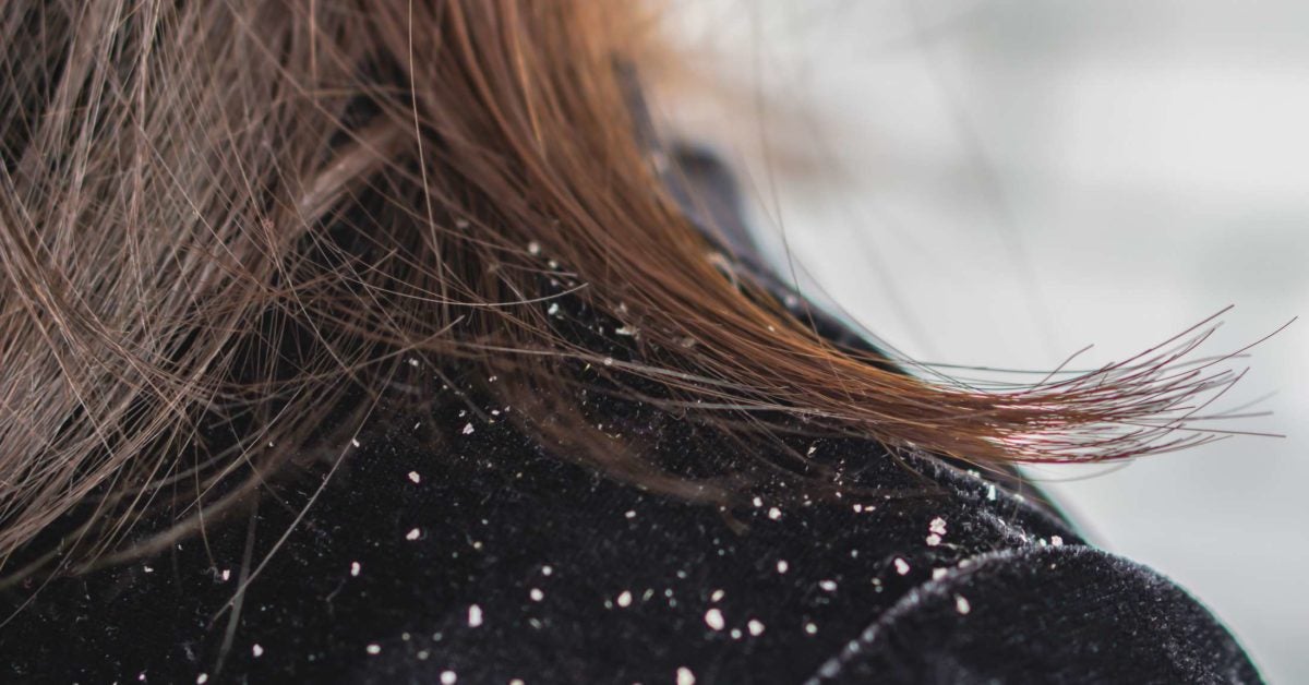 Can Dandruff Lead To Hair Loss The Link Causes And Treatments 