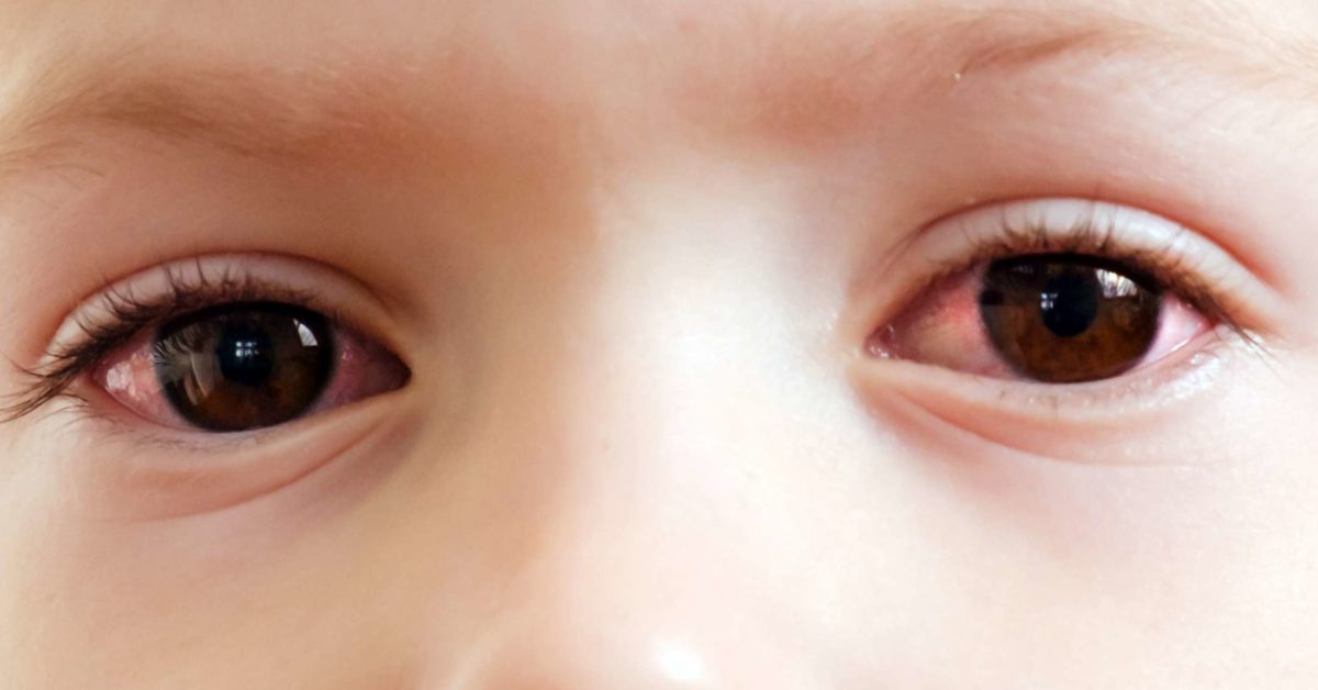 pink-eye-in-toddlers-symptoms-diagnosis-and-treatment