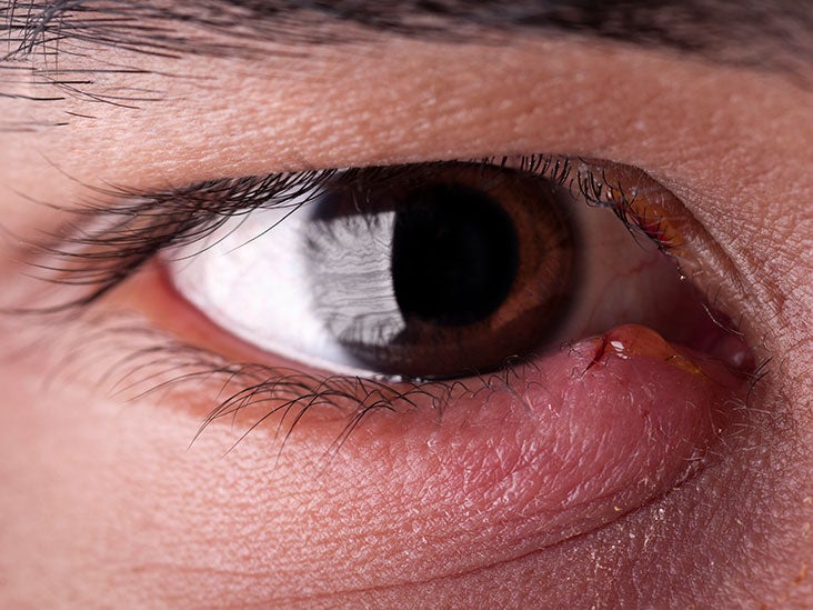 How Long Does A Stye Last Duration And Treatment