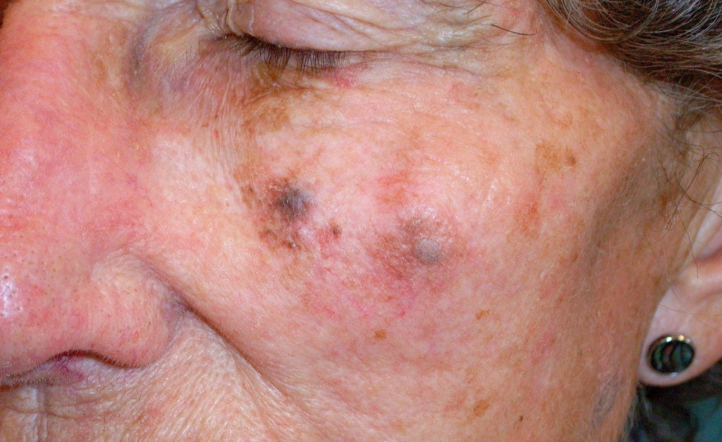 Lentigo maligna melanoma: Pictures, symptoms, and outlook