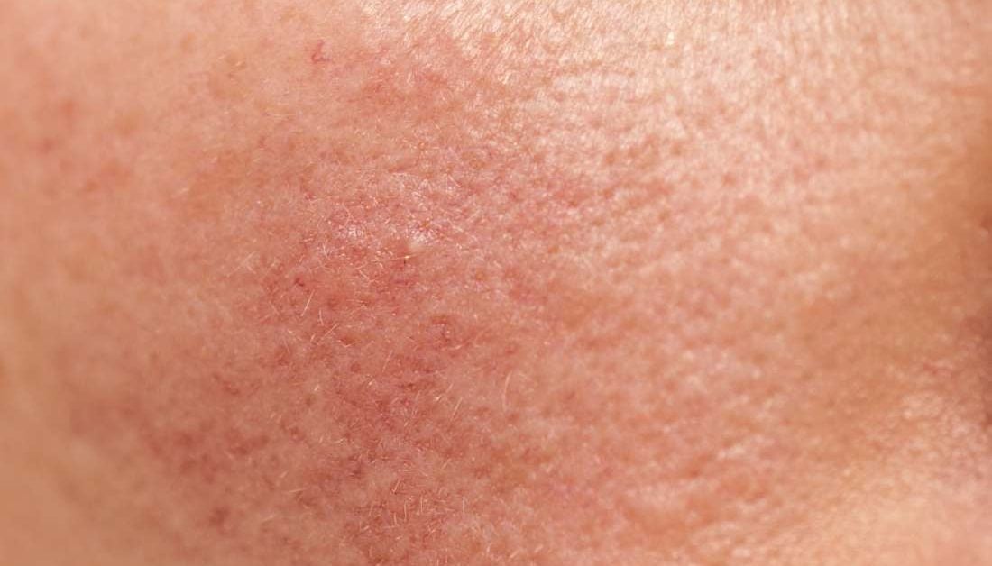 Rosacea Treatment, types, causes, and symptoms Rosacea Treatment, types, causes, and symptoms