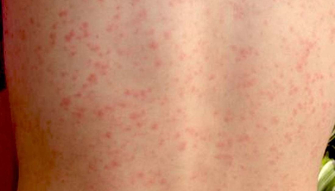 Being Around Scarlet Fever When Pregnant