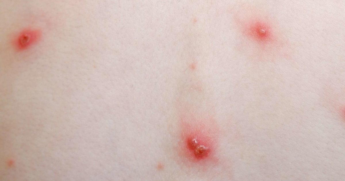 Chickenpox Symptoms Treatment Stages And Causes