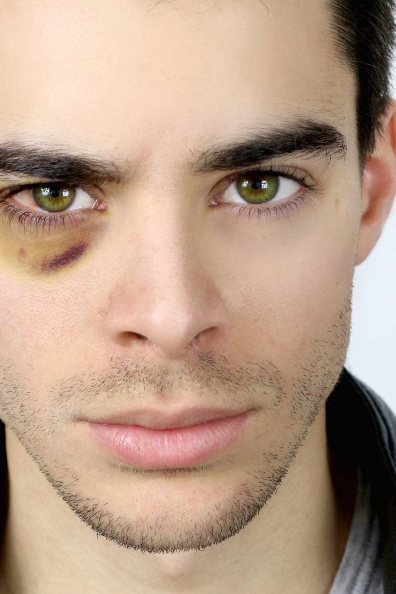 Black Eye Causes Effects Treatment And Prevention