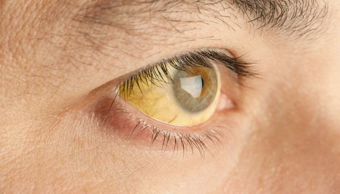 yellowing-my-eyes-my-eyes-are-getting-yellow-pain-concern