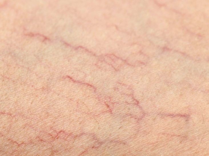 What Causes Broken Blood Vessels In Lips Lipstutorial