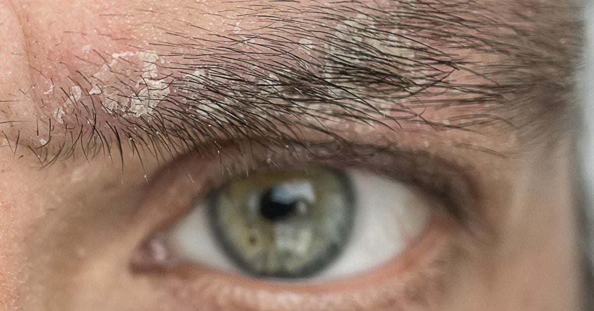 Psoriasis versus rosacea Differences, treatment, and other conditions