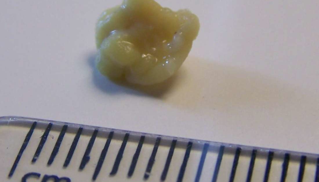 Tonsil stones Causes, symptoms, and treatment