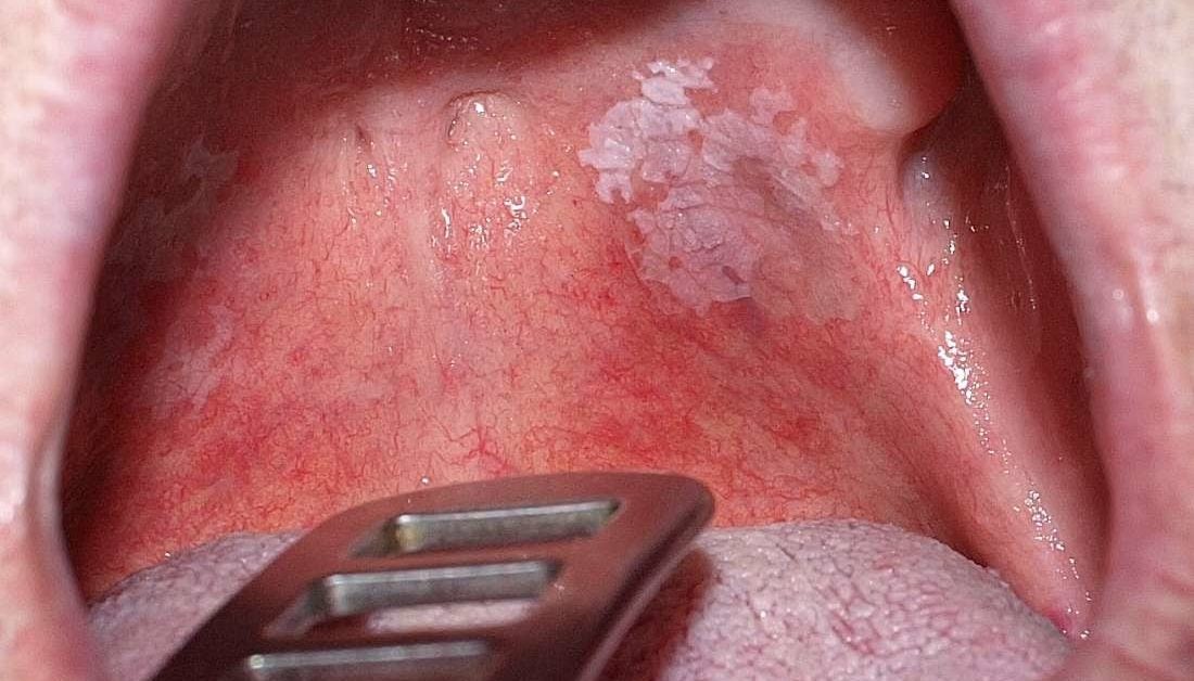 Oral Thrush Cause Red Throat