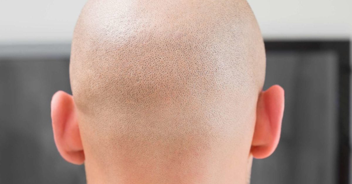 alopecia areata universalis treatment