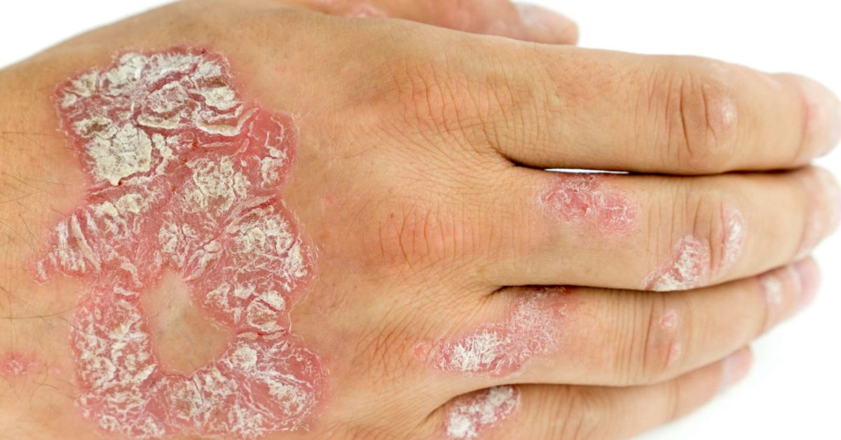 psoriasis peeling skin)