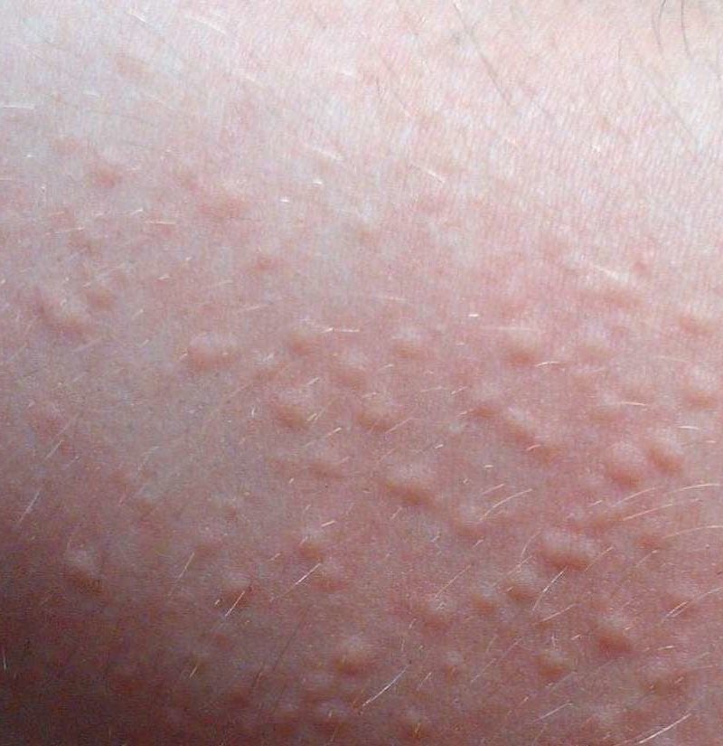 Urticaria Hives Types Symptoms And Causes Symptomstips Images