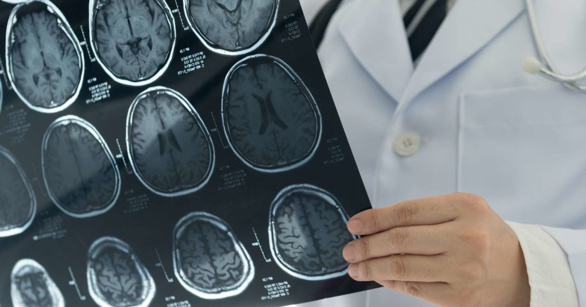 'Too much' brain calcium may cause Parkinson's