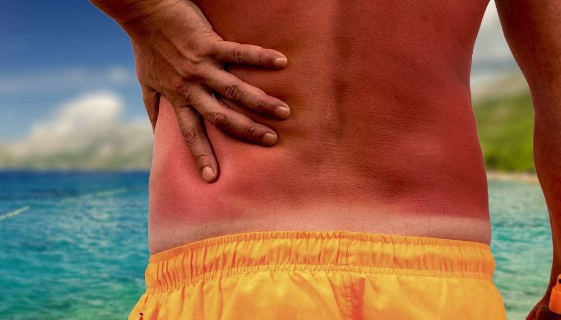 Hell S Itch How To Treat A Severe Sunburn Itch