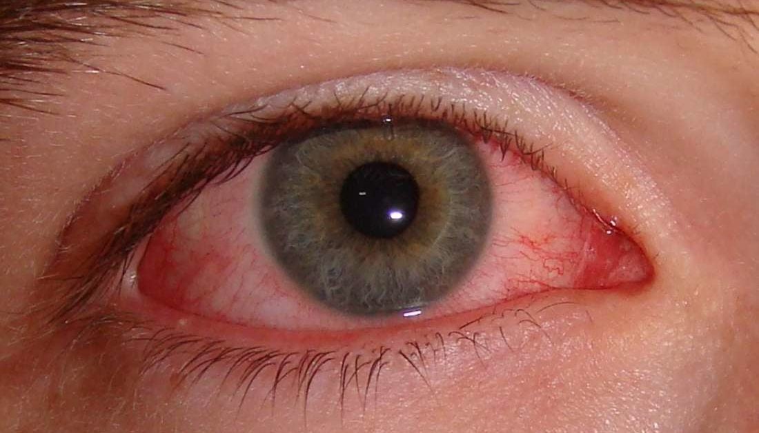 How Long Does Pink Eye Last 7 Signs You Are Still Contagious