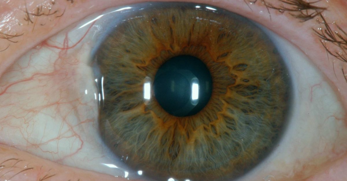 bumps-on-eyeball-causes-types-and-treatment