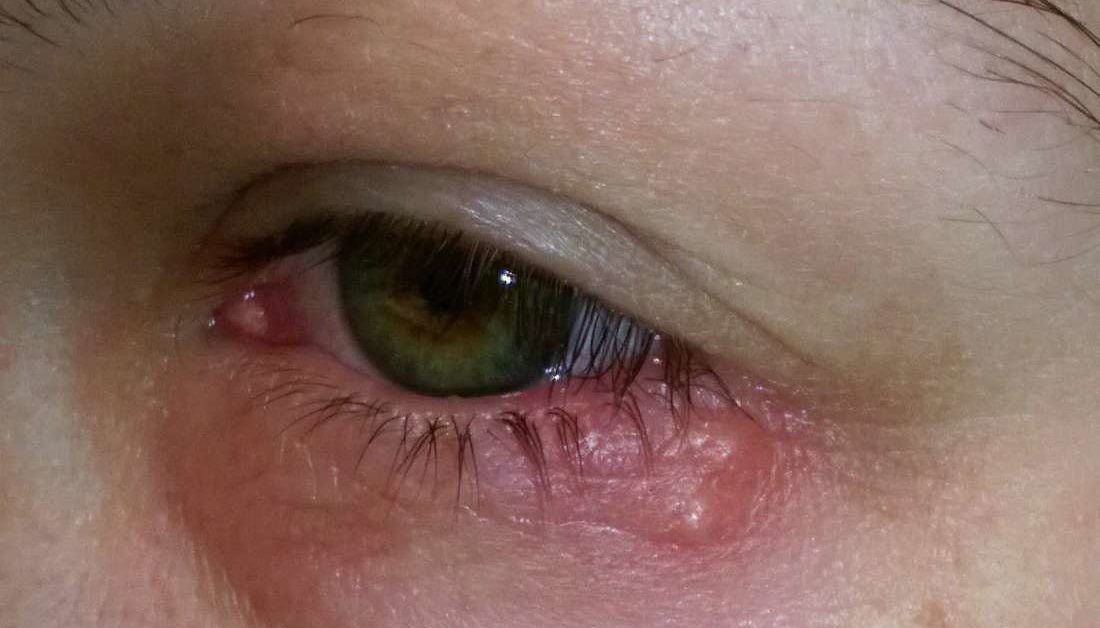 eye-herpes-pictures-symptoms-and-types