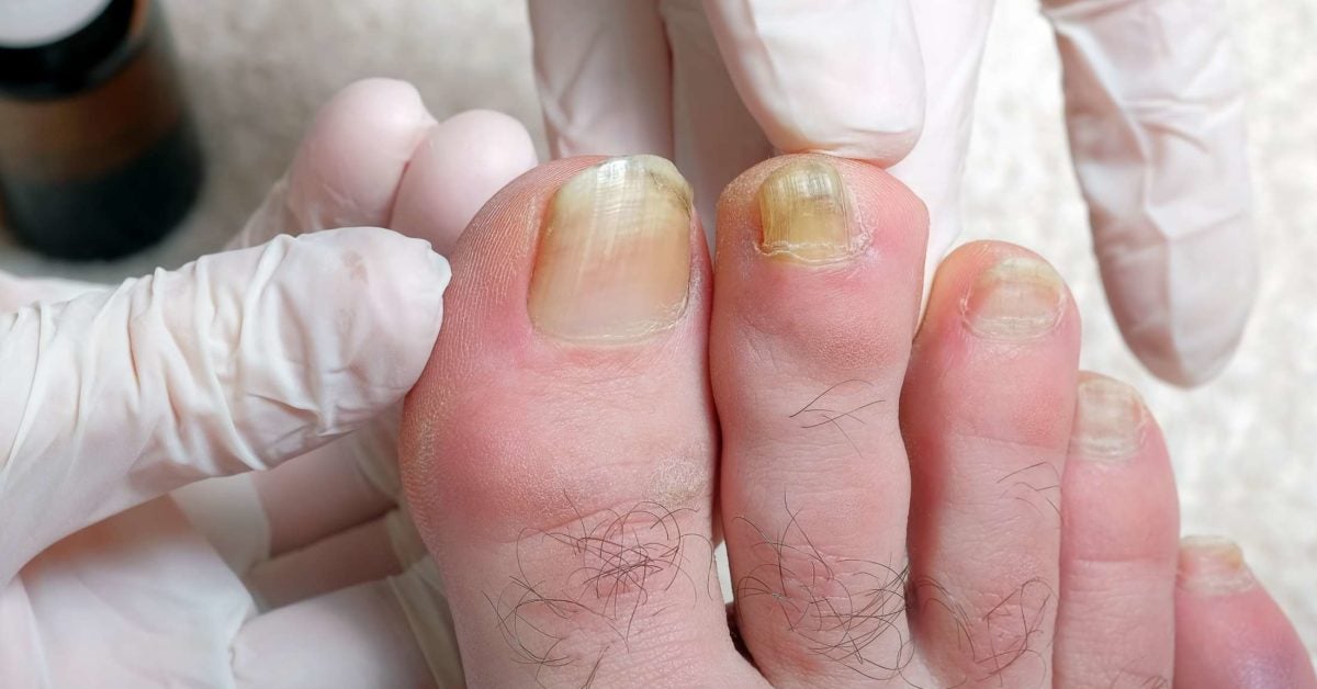 why-are-my-toenails-yellow-causes-and-treatment