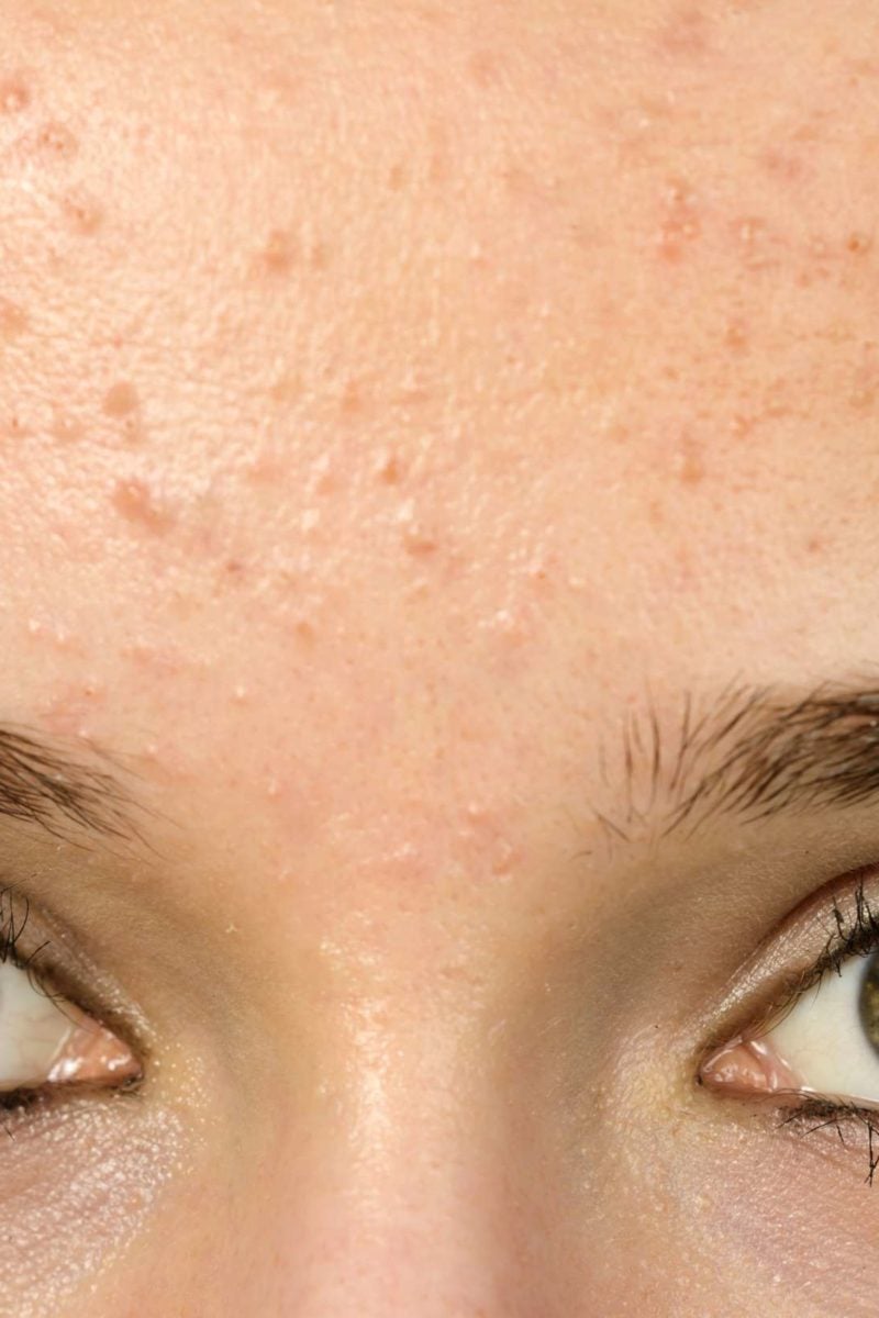 What Can Forehead Acne Mean