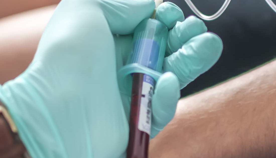 How To Read Syphilis Test Results Rapid Plasma Reagin Test For