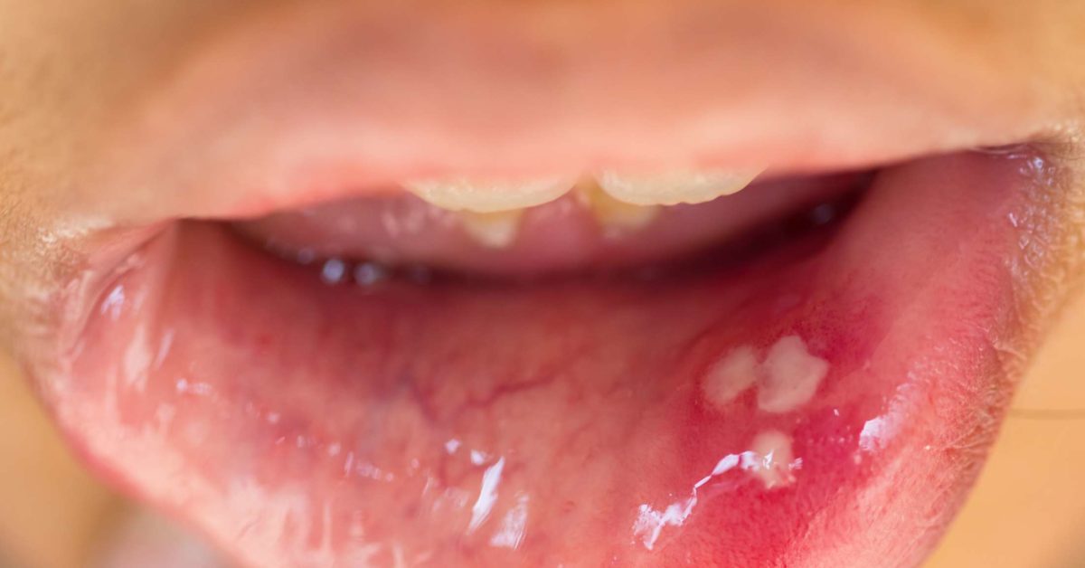 What Do Hpv Warts Look Like On Tongue