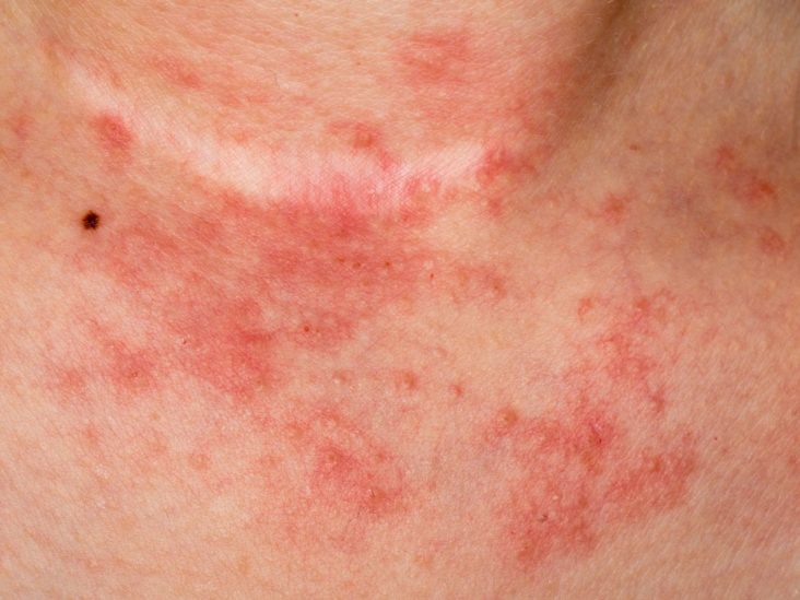 vrăjind eczema în varicoză