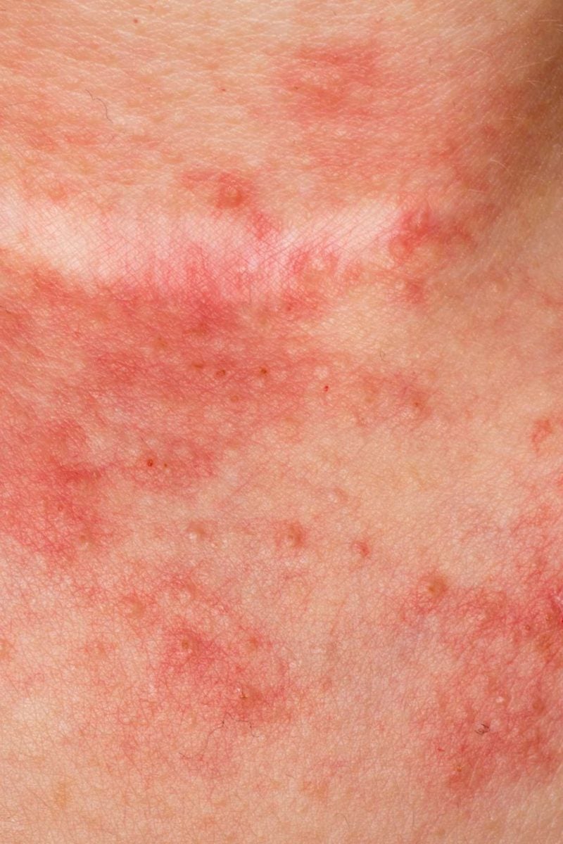 6-tipos-de-eczema-s-ntomas-y-causas