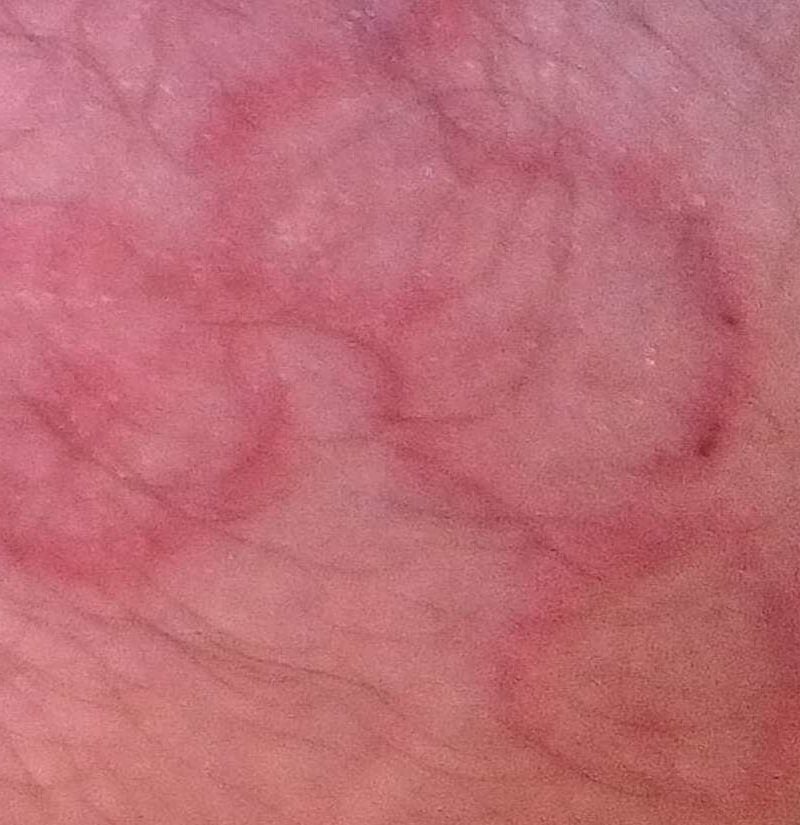 Nummular eczema vs. ringworm Symptoms, causes, and treatment