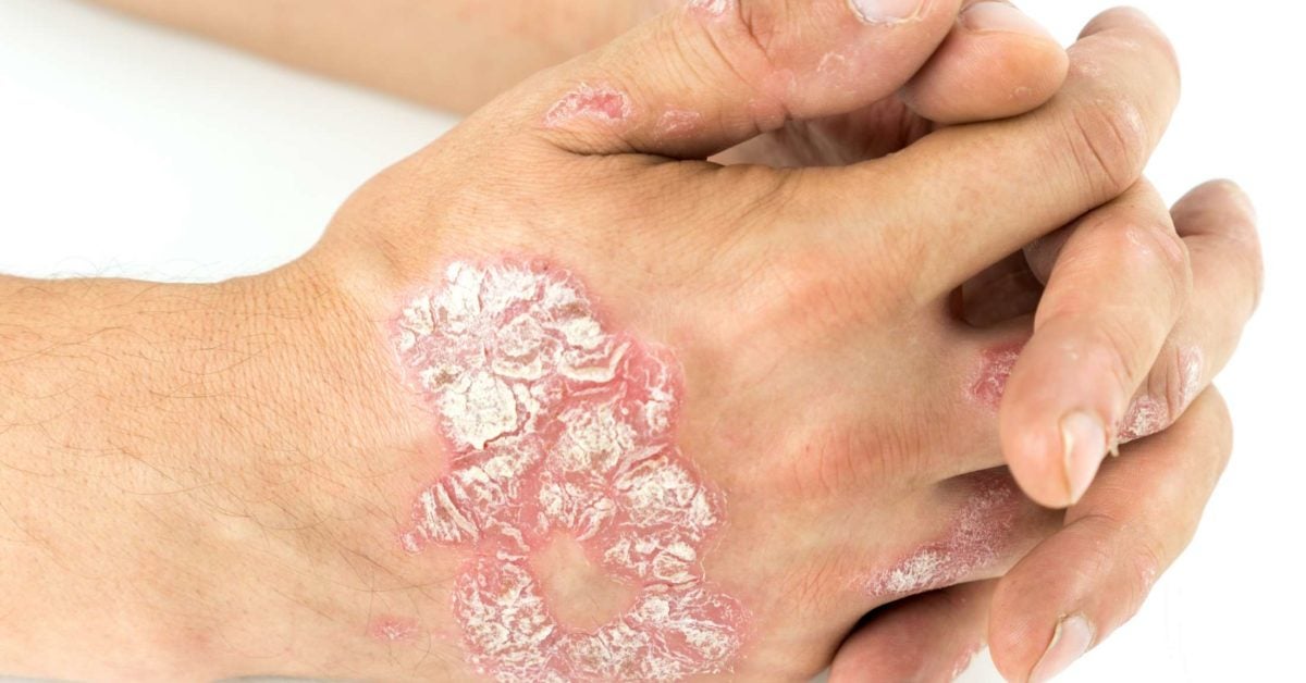 Plaque psoriasis Pictures, symptoms, and severity