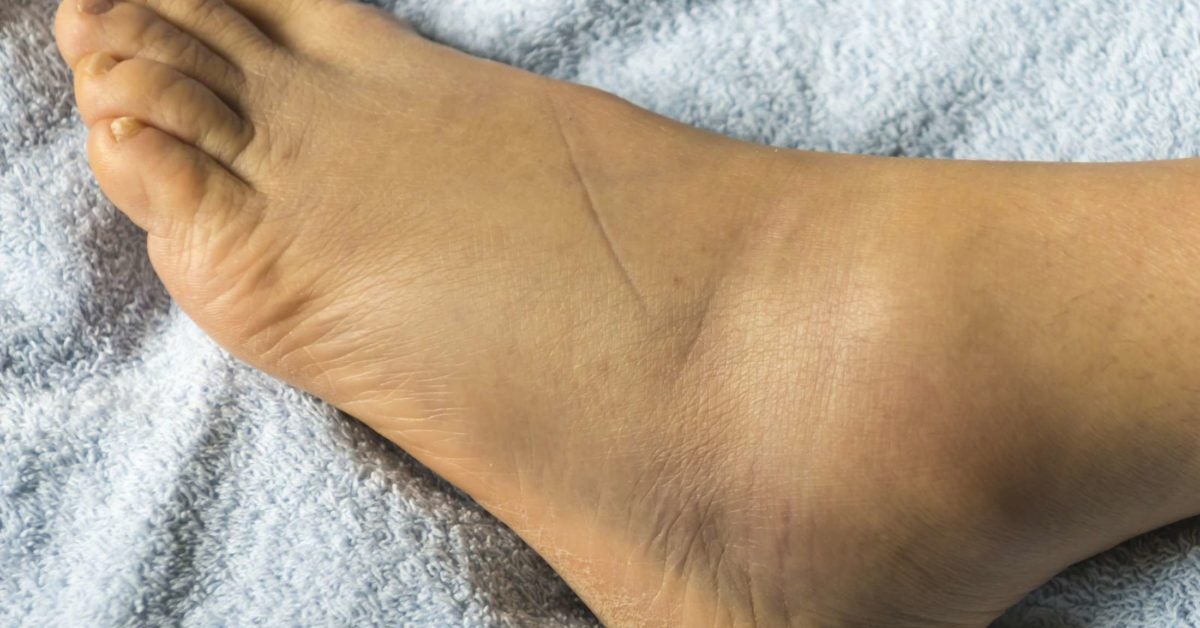 Swollen feet 15 causes, treatments, and home remedies