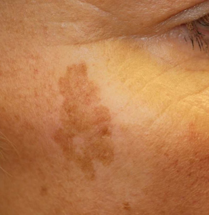 what are light brown spots on skin | Adiklight.co