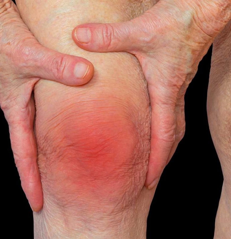 anemia y hematomas