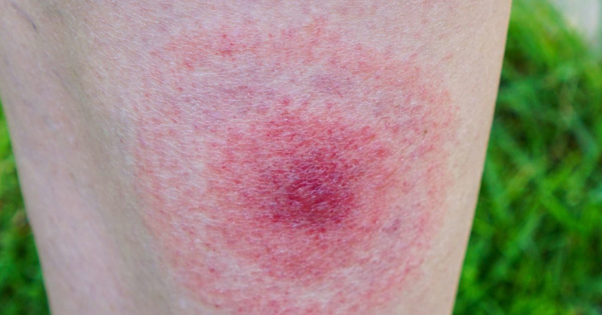 Lyme disease rash Symptoms, stages, and identification