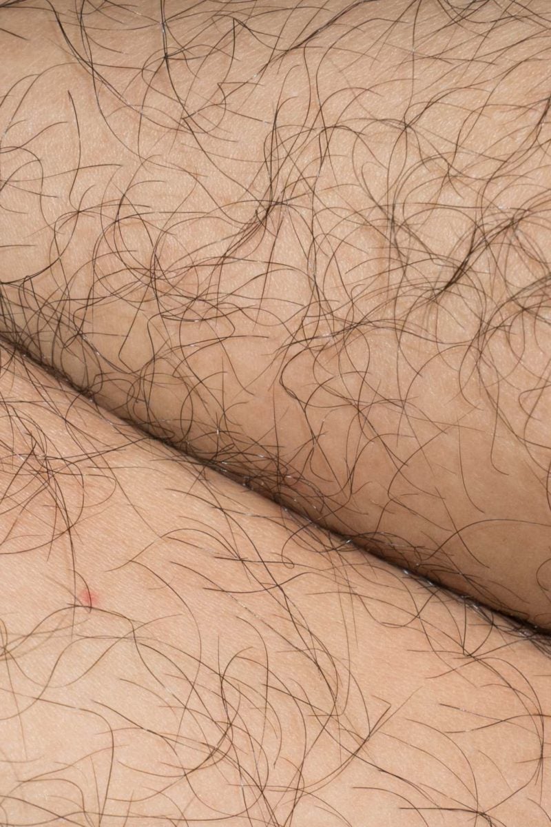 Excessive Or Unwanted Hair In Women Causes And Natural Treatments