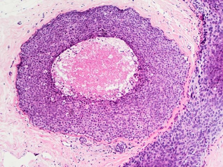 squamous cell carcinoma in situ of the cervix squamous cell carcinoma in situ of the cervix