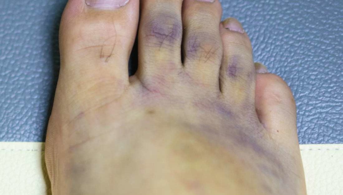 Dark Purple Feet In Elderly