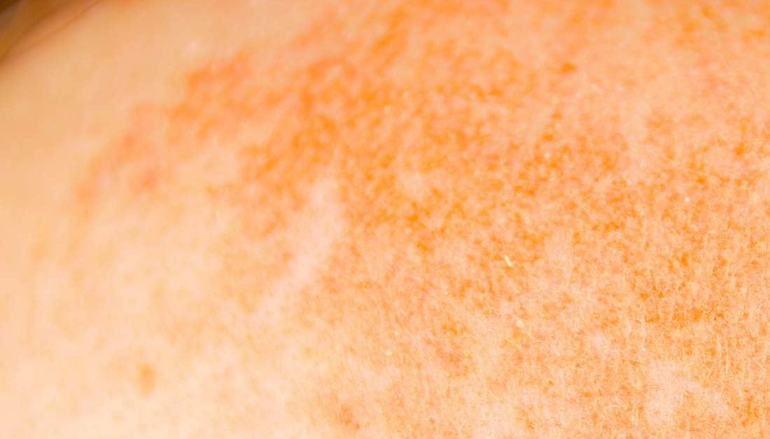 hyperpigmentation-treatment-types-and-causes